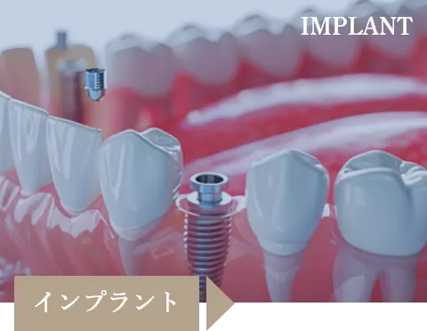 インプラント