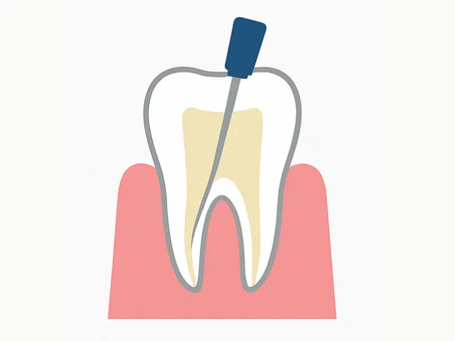 根管の洗浄をして下準備