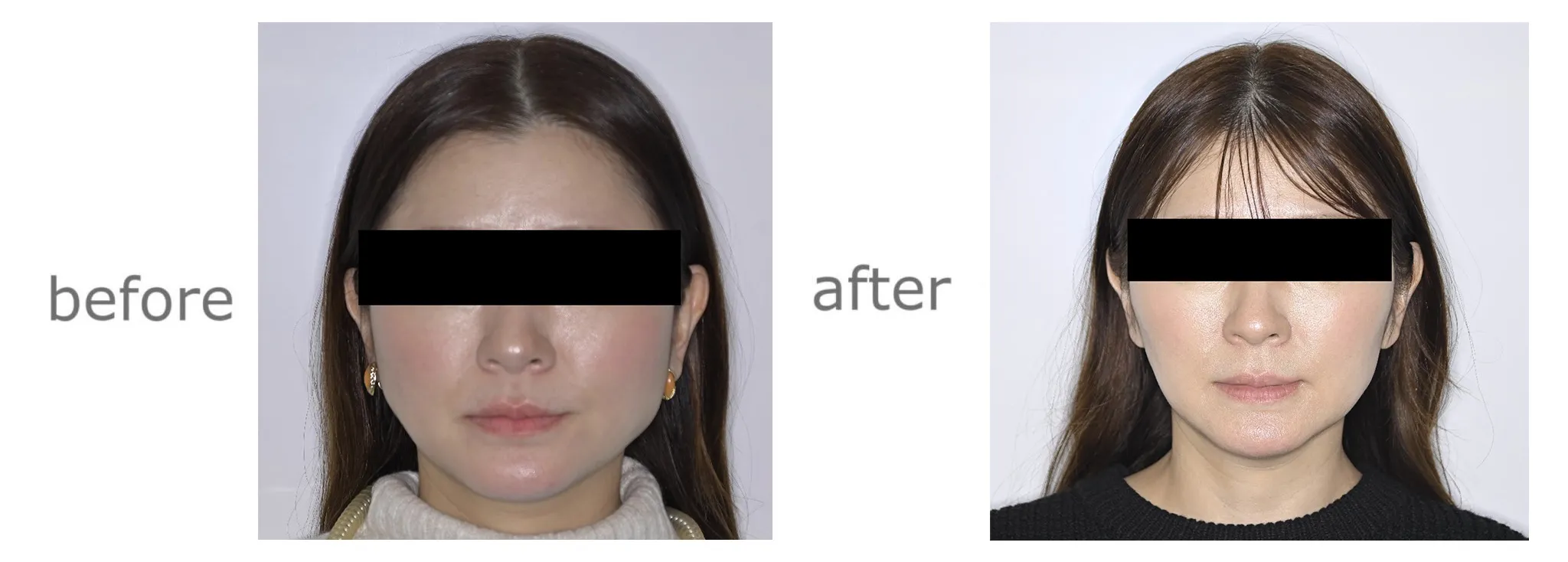 ボツリヌス症例