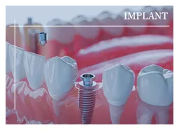 インプラント